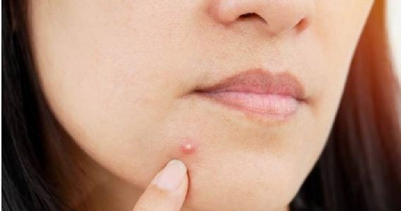 Skin Care Tips: पिंपल्स से हैं परेशान? ये 7 फूड्स करेंगे उपाय, त्वचा लगेगी जवान और ग्लोइंग