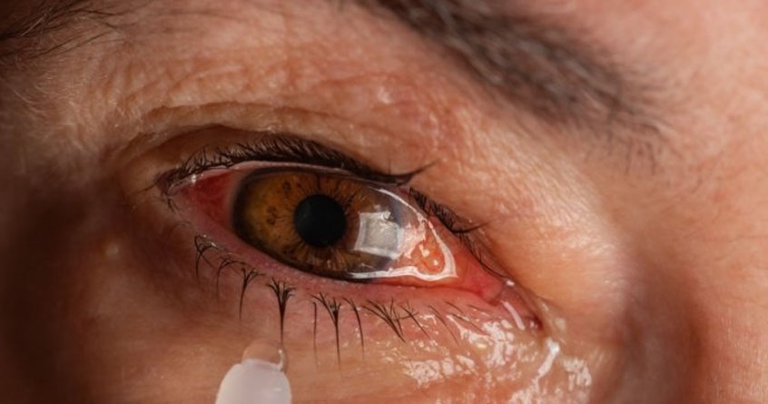 Conjunctivitis - Abhijeet Bharat