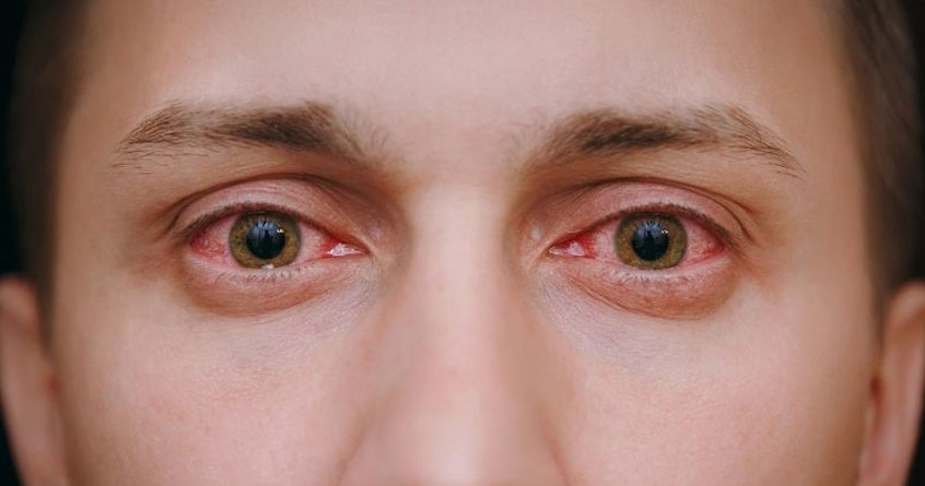 Conjunctivitis cases increasing in Delhi NCR - Abhijeet Bharat