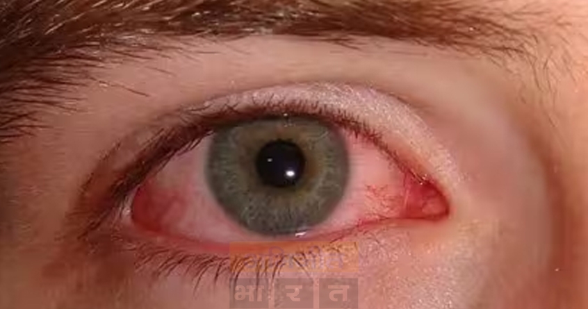 conjunctivitis - Abhijeet bharat