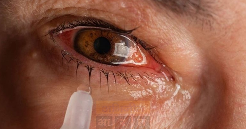 chhattisgarh enterovirus found in samples of patients affected by conjunctivitis in the state - Abhijeet Bharat