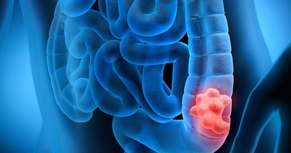 'महाज्योति' के शोधकर्ता ने खोजा 'कोलन कैंसर' के लिए प्रभावी 'कैप्सूल'